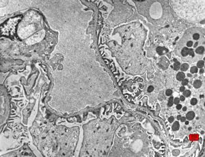 M,13y. | thin basement membrane syndrome M,13y. | thin basement membrane syndrome